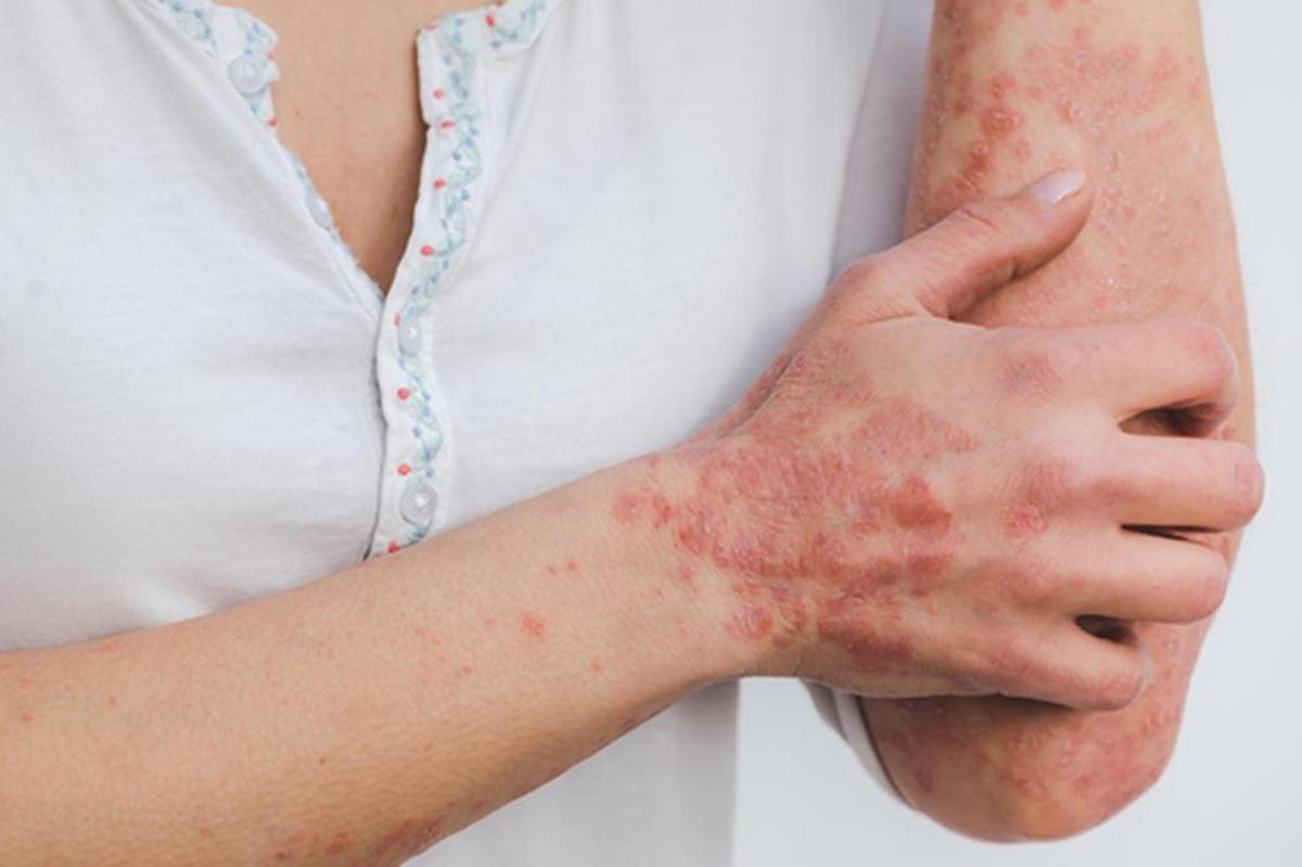 Descubren un mecanismo clave en la psoriasis y un fármaco contra la leucemia que reduce la inflamación