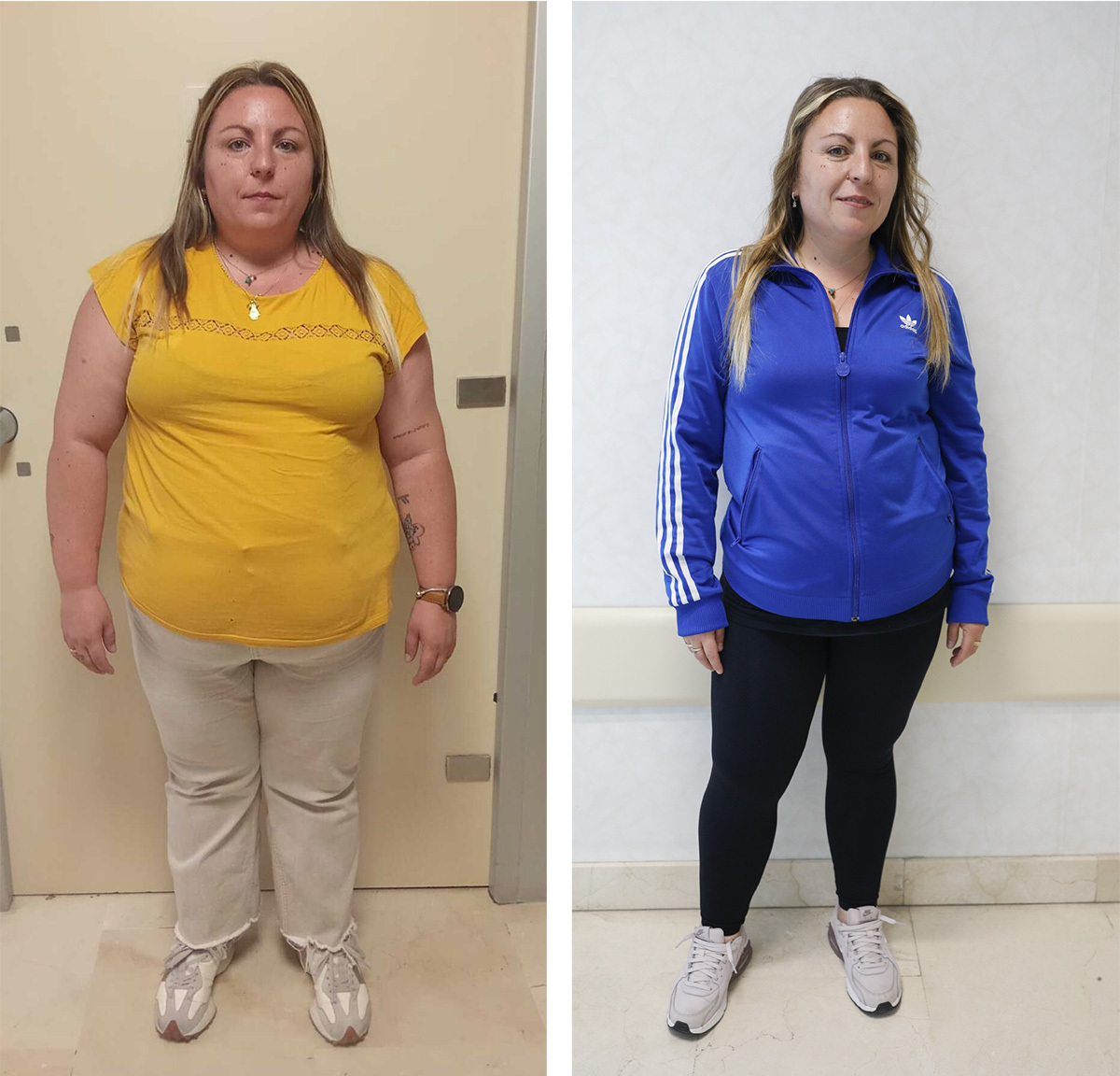 Imagen del endoscopio flexible y la cámara utilizada en la endoscopia bariátrica