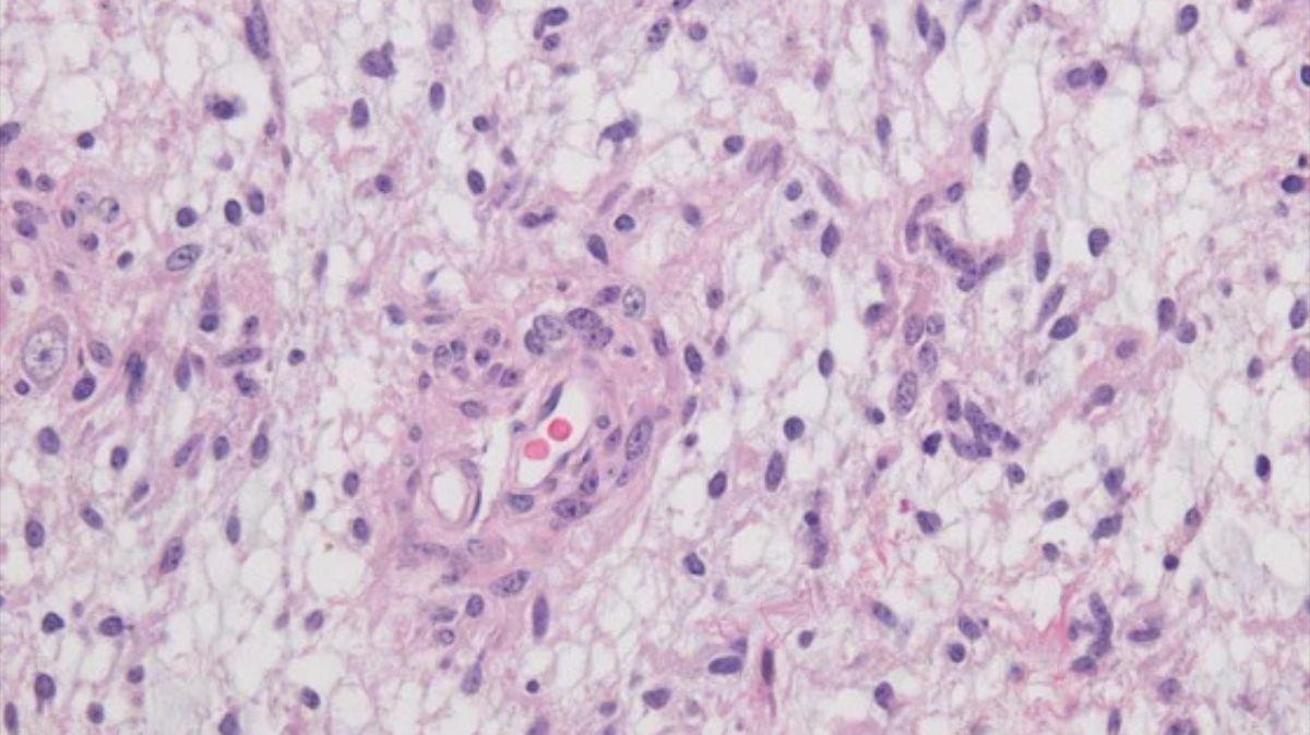 Lámina histológica de tejido cerebral analizada por la IA Hetairos, mostrando la detección de subtipos tumorales.