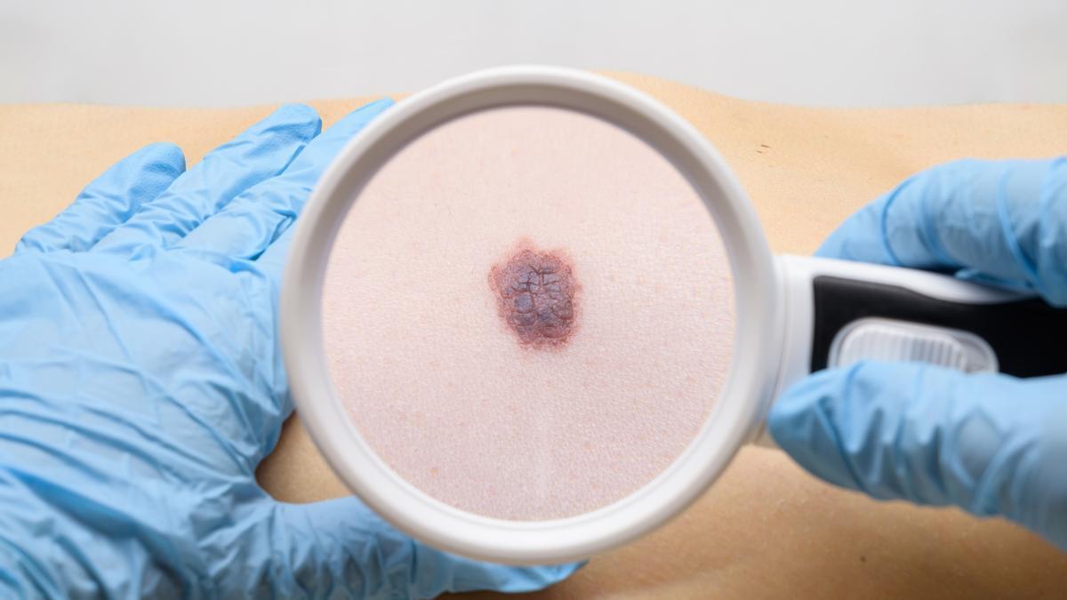 Sol: el principal factor de riesgo cutáneo que dispara los casos de cáncer de piel