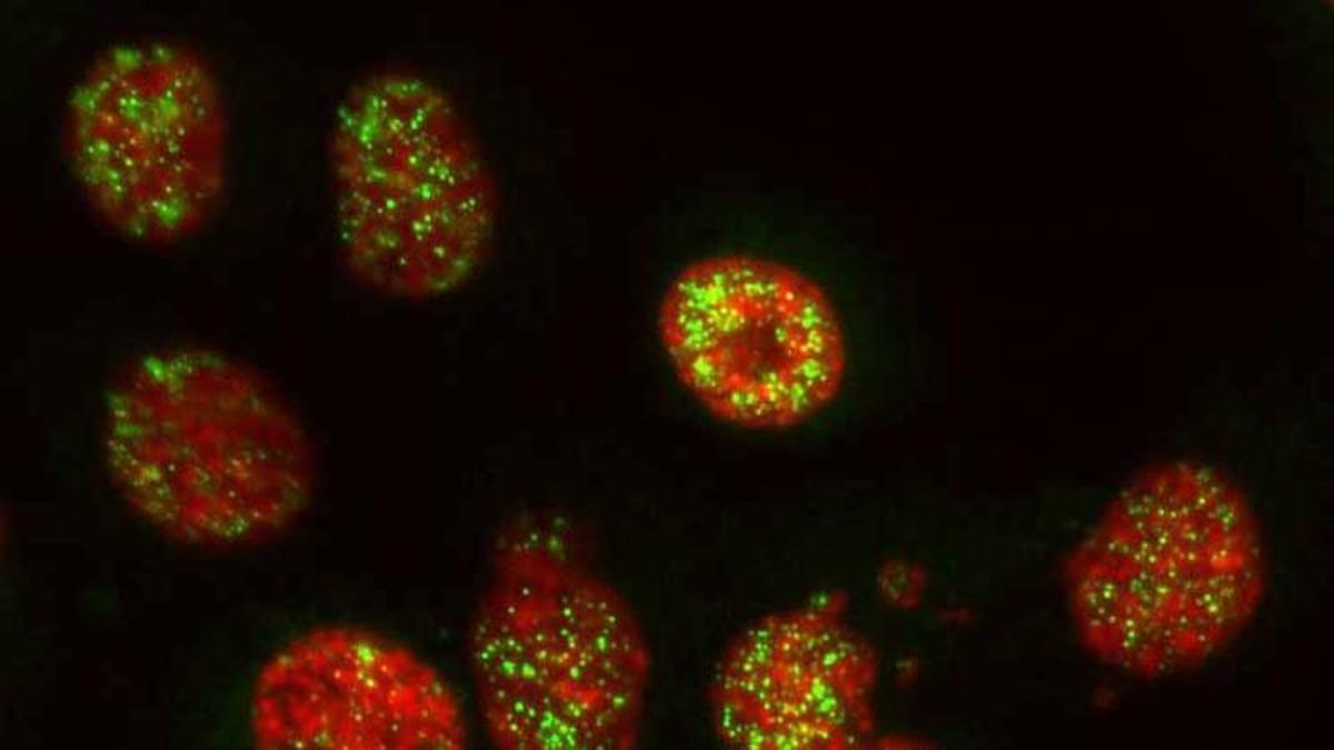 Inhibición de PARP2, la nueva esperanza contra el cáncer de páncreas